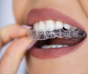 Invisalign in der Türkei - Cosmedica Dental