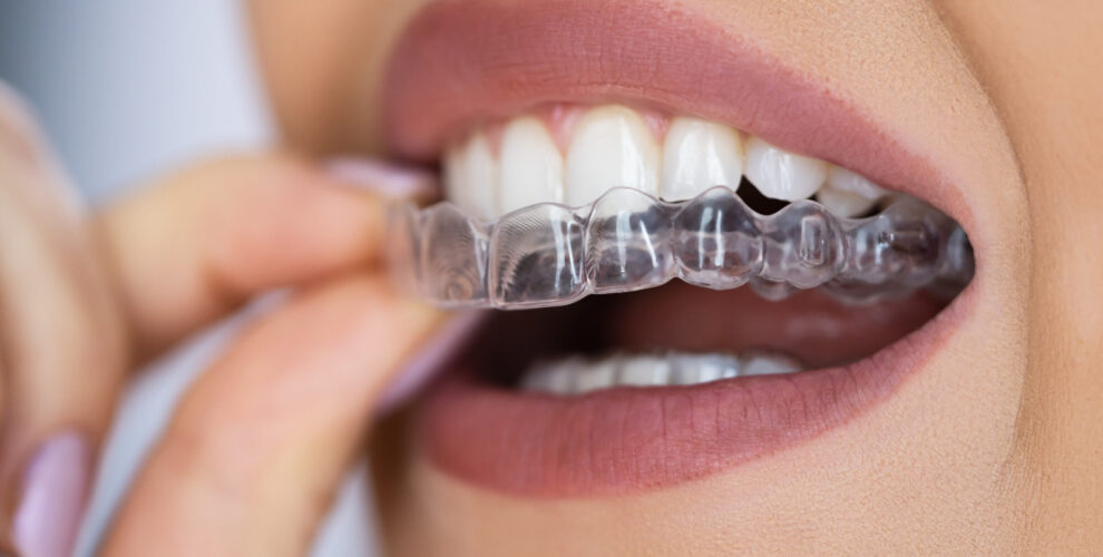 Invisalign in der Türkei - Cosmedica Dental
