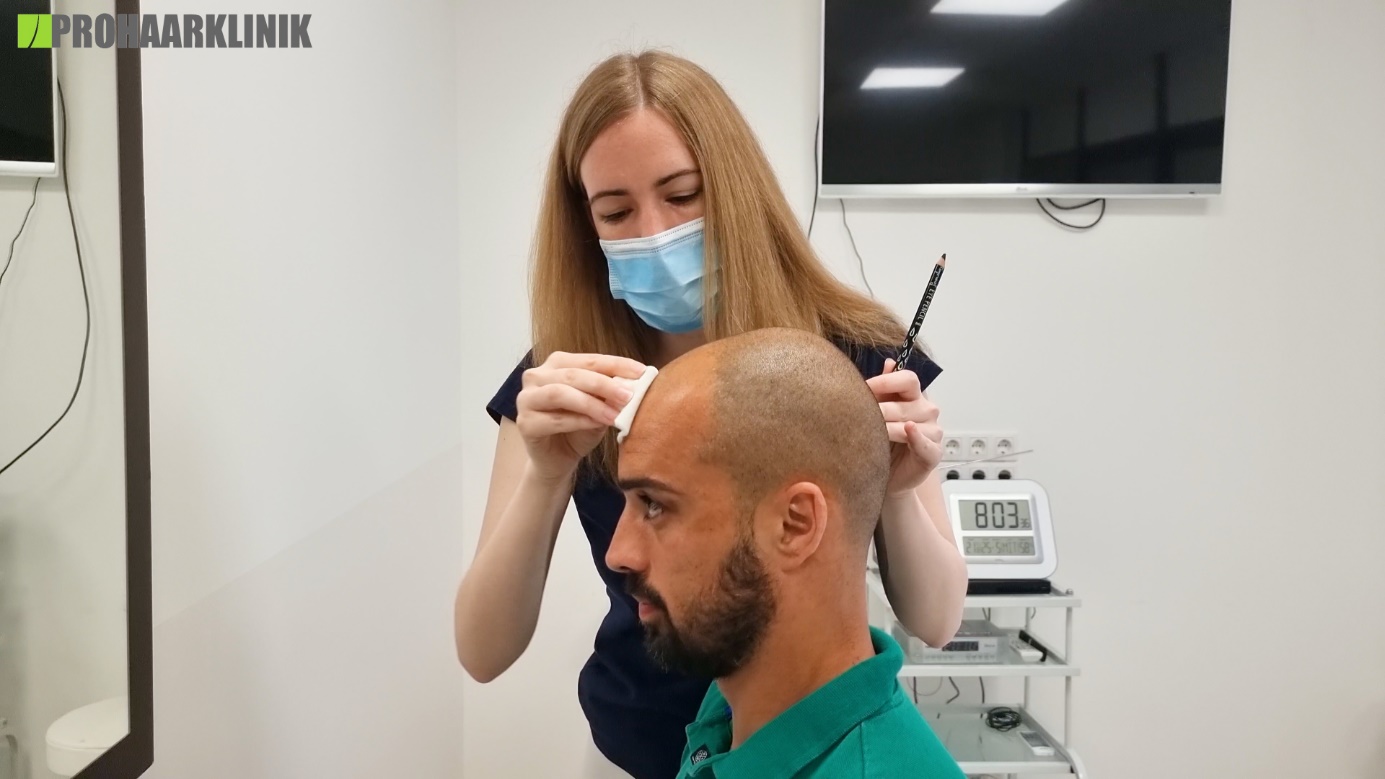 Titelbild zu „Häufig gestellte Fragen zur Haartransplantation“