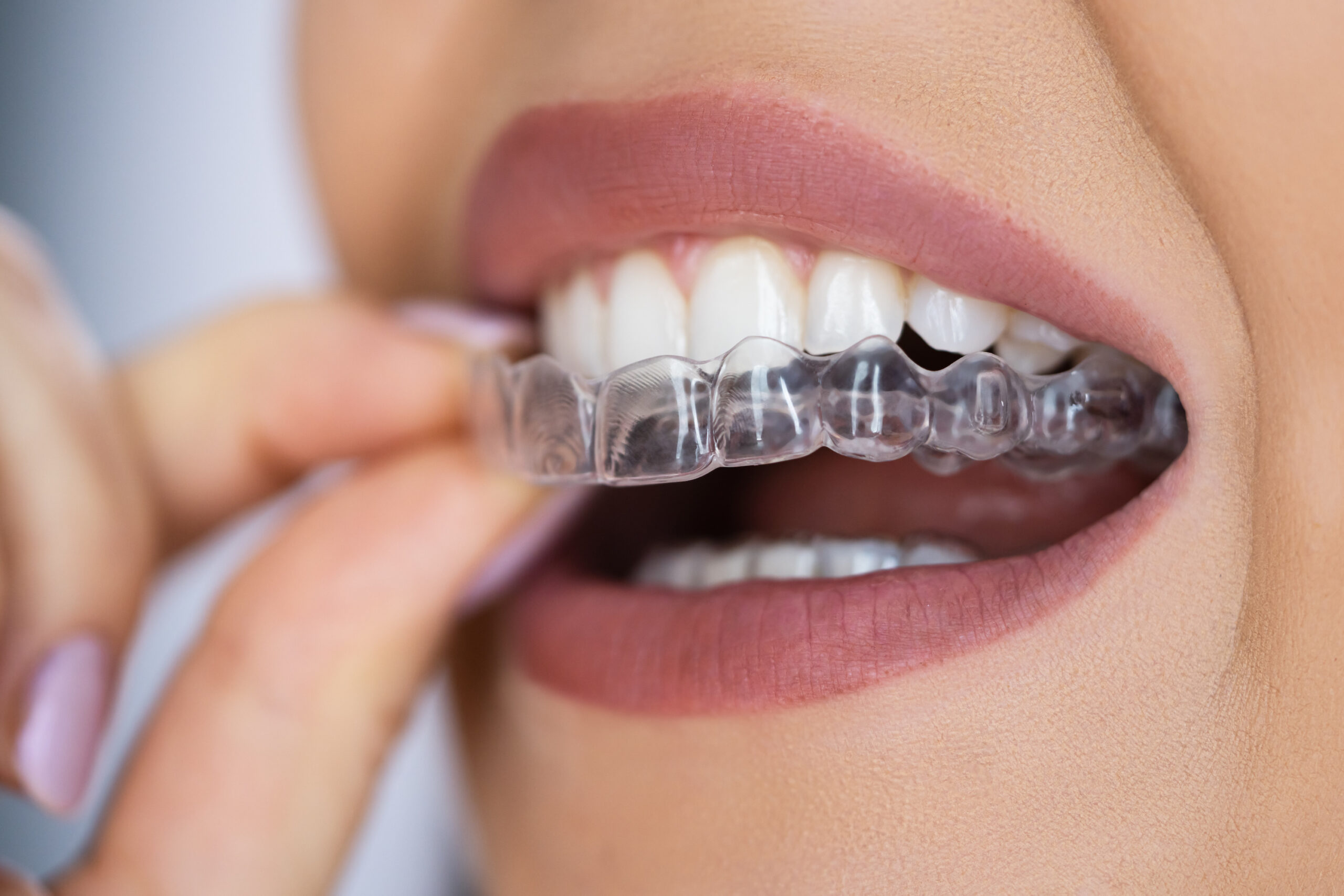 Titelbild zu „Invisalign Türkei: Das Lächeln deiner Träume erreichen“